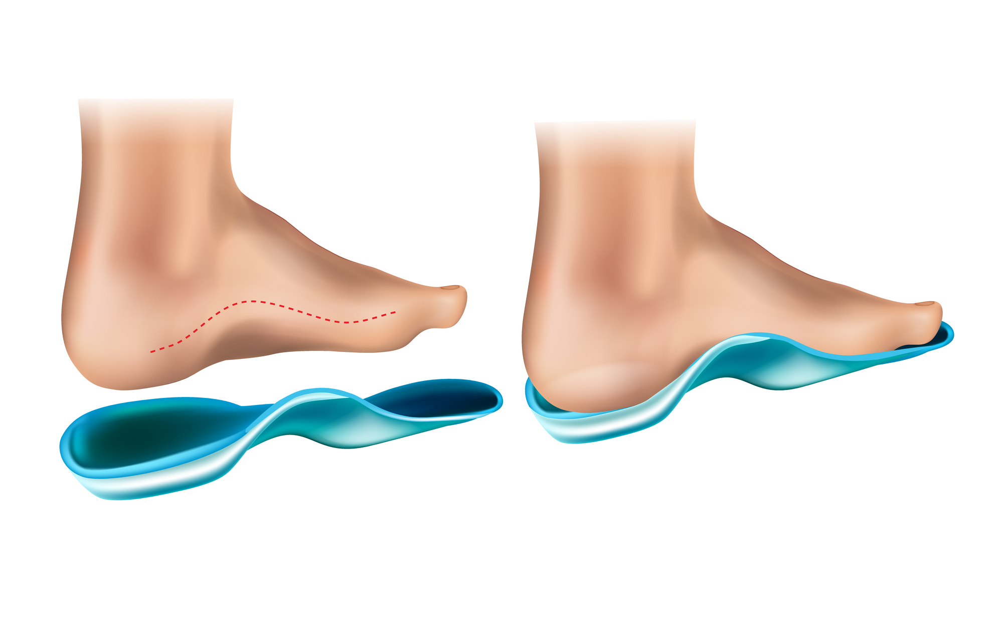 The Different Types of Foot Orthotics